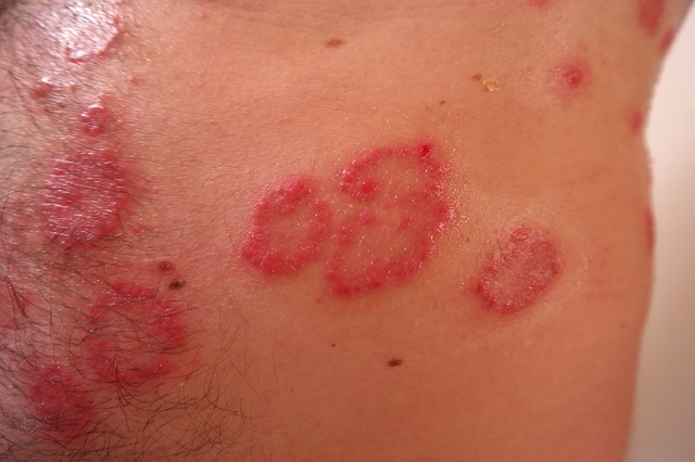 Aké prírodné výrobky vám pomôžu zmierniť psoriázu?
